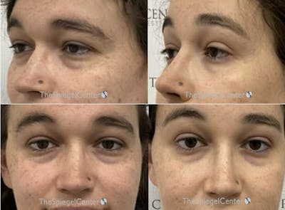Rhinoplasty Before & After Gallery - Patient 268386 - Image 1