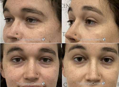 Rhinoplasty Before & After Gallery - Patient 268386 - Image 1