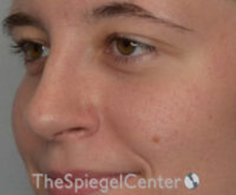 Rhinoplasty Before & After Gallery - Patient 536844 - Image 2