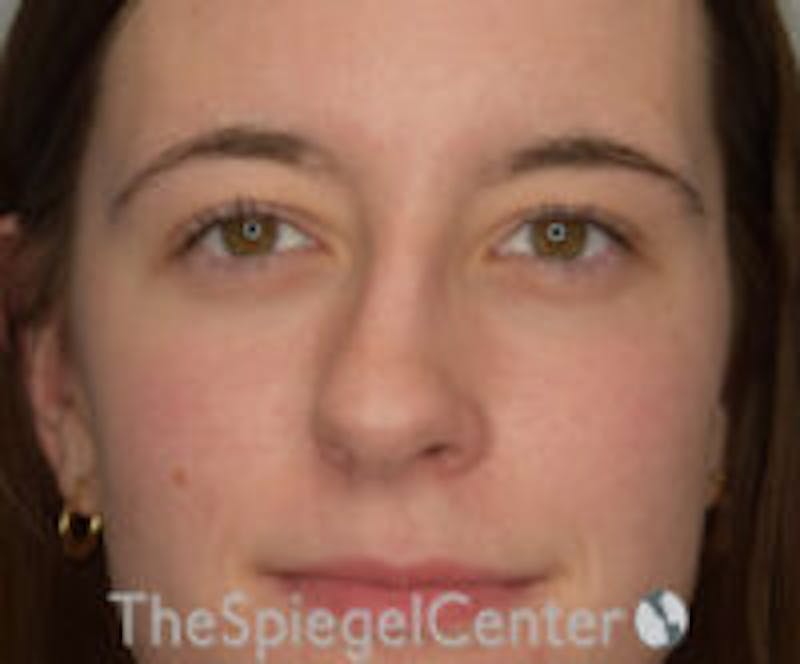 Rhinoplasty Before & After Gallery - Patient 536844 - Image 3