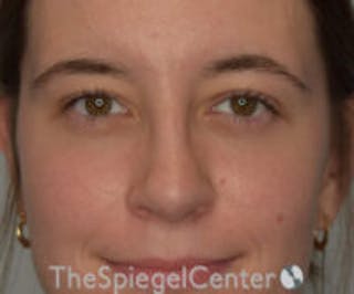 Rhinoplasty Before & After Gallery - Patient 536844 - Image 4