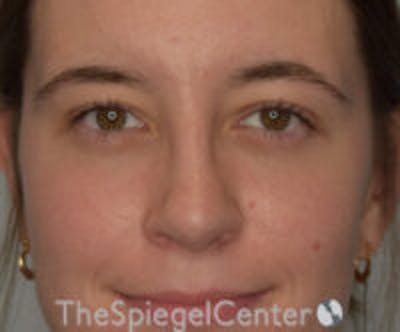 Rhinoplasty Before & After Gallery - Patient 536844 - Image 4