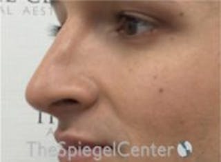 Rhinoplasty Before & After Gallery - Patient 217779 - Image 2