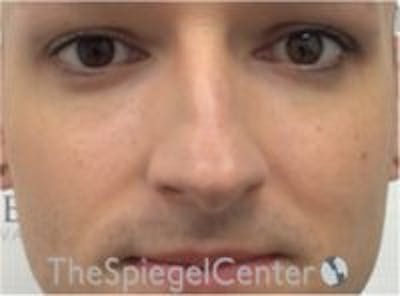 Rhinoplasty Before & After Gallery - Patient 217779 - Image 3