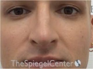 Rhinoplasty Before & After Gallery - Patient 217779 - Image 4