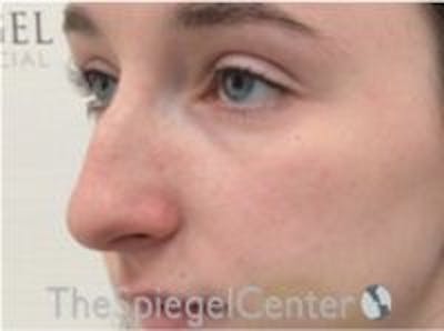 Rhinoplasty Before & After Gallery - Patient 101205 - Image 1