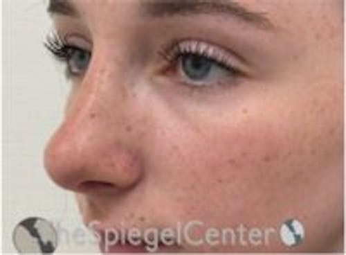 Rhinoplasty Before & After Gallery - Patient 101205 - Image 2