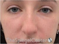 Rhinoplasty Before & After Gallery - Patient 101205 - Image 3