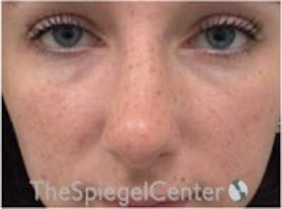 Rhinoplasty Before & After Gallery - Patient 101205 - Image 4