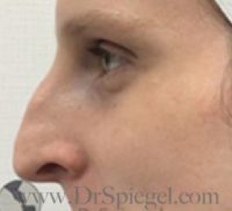 Rhinoplasty Before & After Gallery - Patient 155125 - Image 1