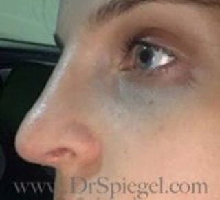 Rhinoplasty Before & After Gallery - Patient 155125 - Image 2