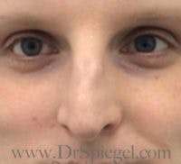 Rhinoplasty Before & After Gallery - Patient 155125 - Image 3