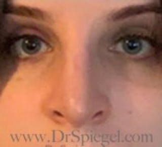 Rhinoplasty Before & After Gallery - Patient 155125 - Image 4