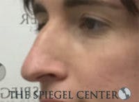 Rhinoplasty Before & After Gallery - Patient 198047 - Image 1