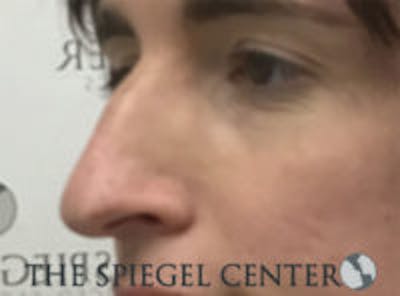 Rhinoplasty Before & After Gallery - Patient 198047 - Image 1