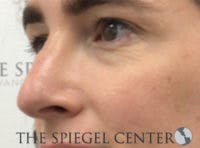 Rhinoplasty Before & After Gallery - Patient 198047 - Image 2