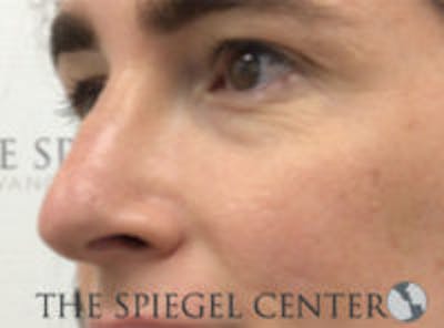 Rhinoplasty Before & After Gallery - Patient 198047 - Image 2