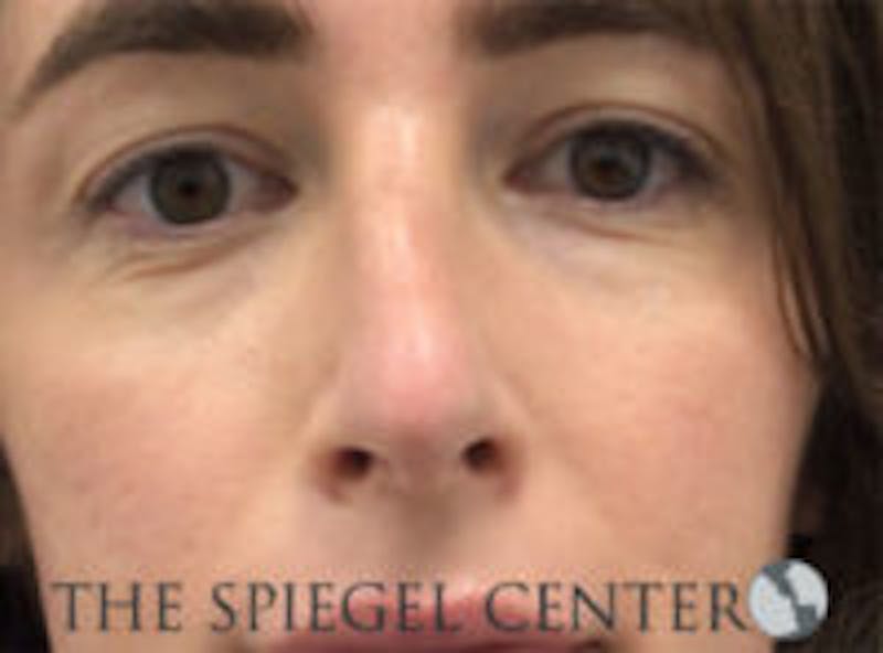 Rhinoplasty Before & After Gallery - Patient 198047 - Image 4