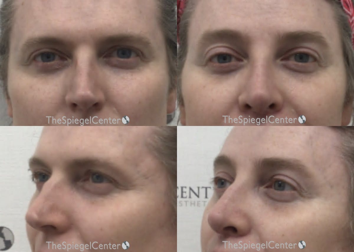 Rhinoplasty Before & After Gallery - Patient 171868 - Image 1