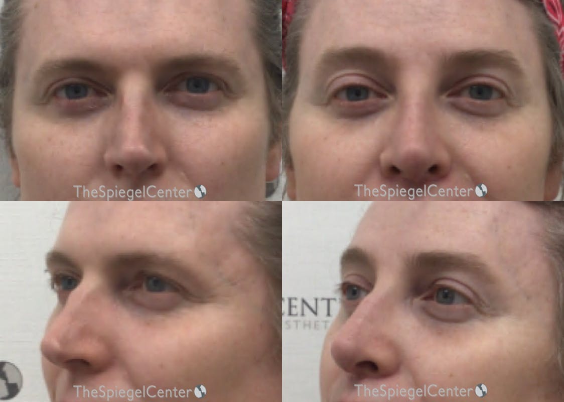 Rhinoplasty Before & After Gallery - Patient 171868 - Image 1