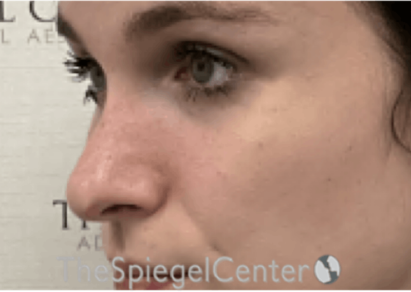 Rhinoplasty Before & After Gallery - Patient 735366 - Image 2