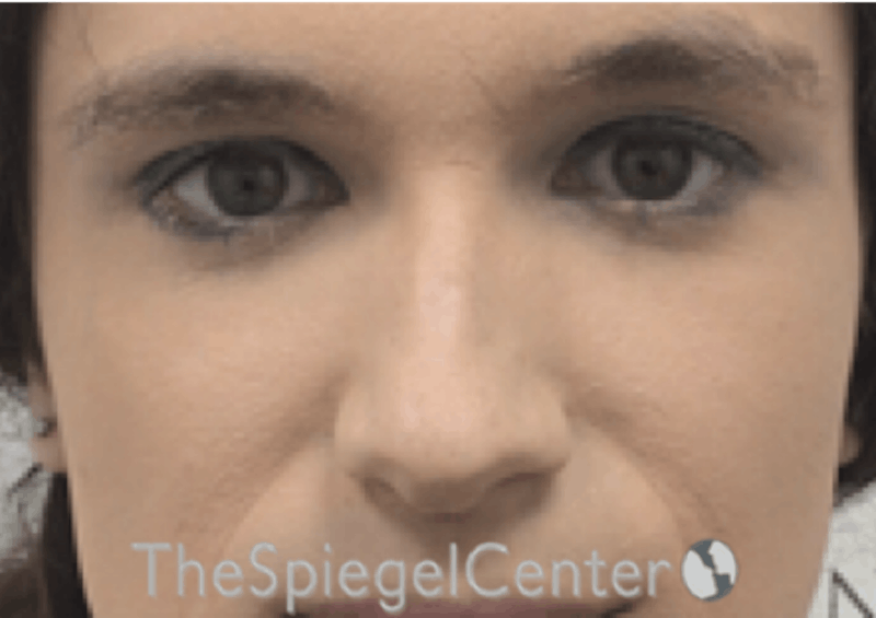 Rhinoplasty Before & After Gallery - Patient 735366 - Image 3