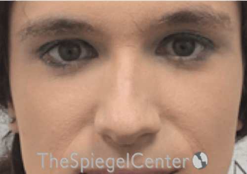 Rhinoplasty Before & After Gallery - Patient 735366 - Image 3