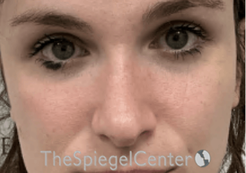 Rhinoplasty Before & After Gallery - Patient 735366 - Image 4