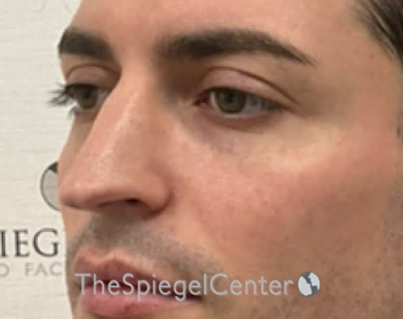 Rhinoplasty Before & After Gallery - Patient 233036 - Image 1