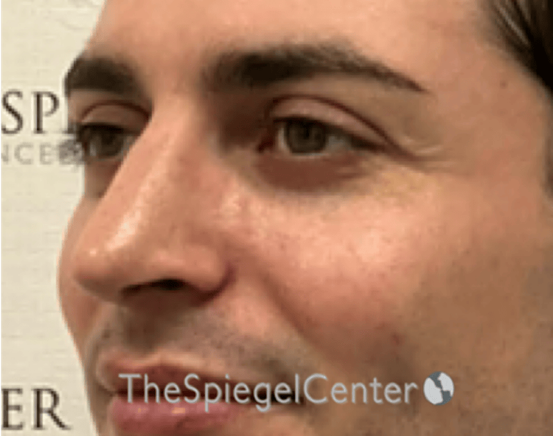 Rhinoplasty Before & After Gallery - Patient 233036 - Image 2