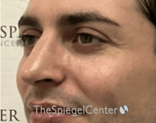 Rhinoplasty Before & After Gallery - Patient 233036 - Image 2
