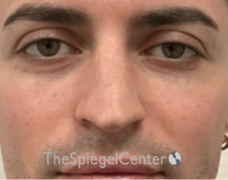 Rhinoplasty Before & After Gallery - Patient 233036 - Image 3