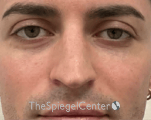 Rhinoplasty Before & After Gallery - Patient 233036 - Image 3