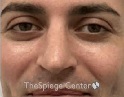 Rhinoplasty Before & After Gallery - Patient 233036 - Image 4