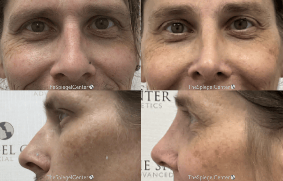 Rhinoplasty Before & After Gallery - Patient 350651 - Image 1