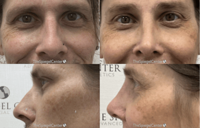 Rhinoplasty Before & After Gallery - Patient 350651 - Image 1