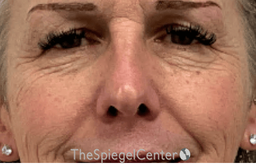 Rhinoplasty Before & After Gallery - Patient 181464 - Image 3