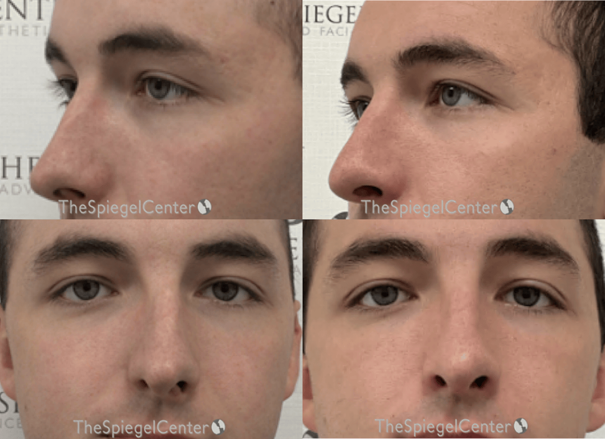 Rhinoplasty Before & After Gallery - Patient 163900 - Image 1