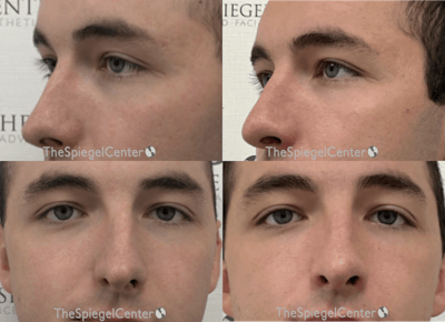 Rhinoplasty Before & After Gallery - Patient 163900 - Image 1