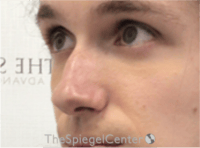 Rhinoplasty Before & After Gallery - Patient 380334 - Image 1