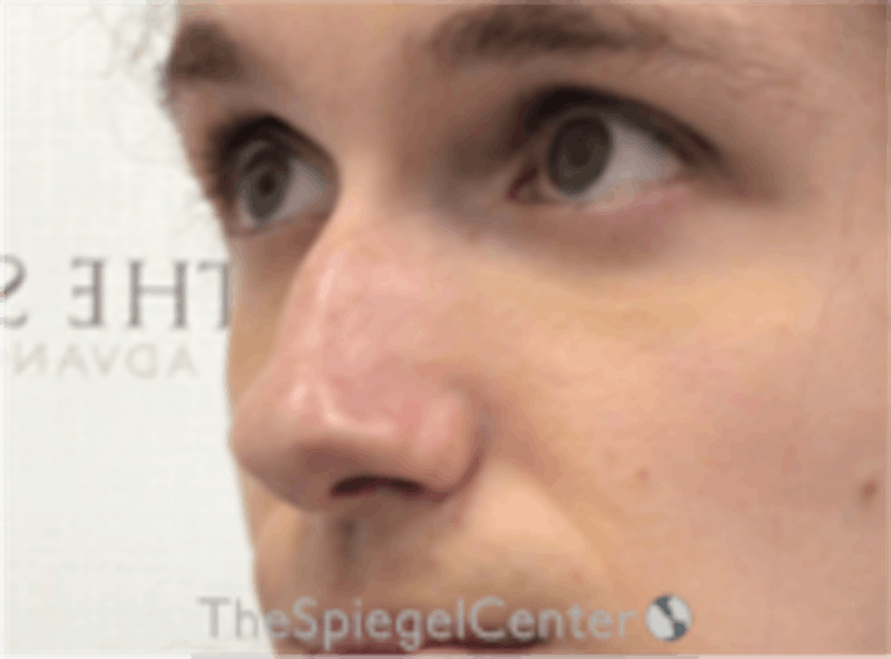 Rhinoplasty Before & After Gallery - Patient 380334 - Image 1