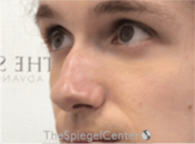 Rhinoplasty Before & After Gallery - Patient 380334 - Image 1