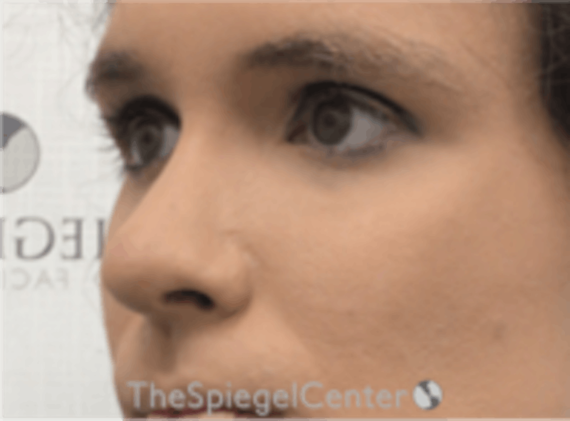 Rhinoplasty Before & After Gallery - Patient 380334 - Image 2