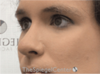 Rhinoplasty Before & After Gallery - Patient 380334 - Image 2