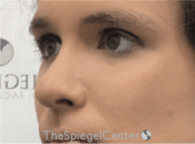 Rhinoplasty Before & After Gallery - Patient 380334 - Image 2