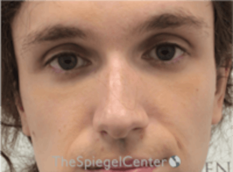 Rhinoplasty Before & After Gallery - Patient 380334 - Image 3