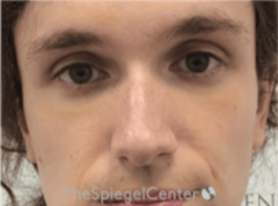 Rhinoplasty Before & After Gallery - Patient 380334 - Image 3