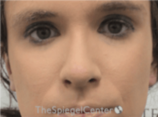 Rhinoplasty Before & After Gallery - Patient 380334 - Image 4