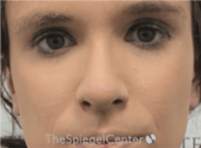 Rhinoplasty Before & After Gallery - Patient 380334 - Image 4