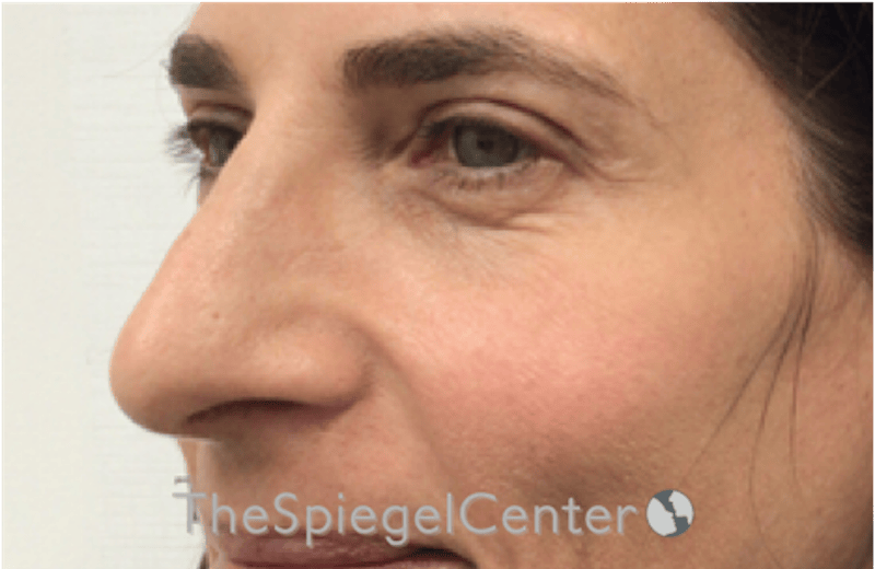 Rhinoplasty Before & After Gallery - Patient 785559 - Image 1